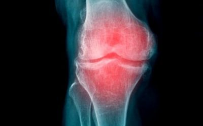 Blog de salud 9 Artrosis de la rodilla: tratamiento, ejercicios y remedios