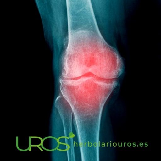 Artrosis de la rodilla - consejos naturales para mejorar Tratamiento y los ejercicios recomendados en caso de artrosis en las rodillas