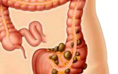 Blog de salud 15 Diverticulitis: Síntomas y dieta ¿Qué es diverticulitis?