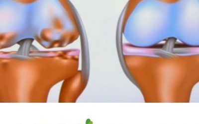 Blog de salud 10 Desgaste del cartilago en la rodilla