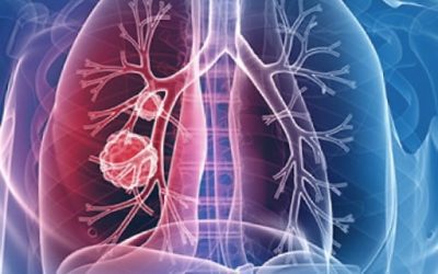 Blog de salud 4 Alergia síntomas: ¿Alergias: Cómo combatirlas naturalmente?
