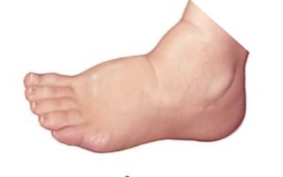 Remedio natural en inflamación