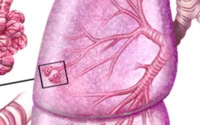 Blog de salud 12 EPOC tratamiento: Remedios naturales para la EPOC